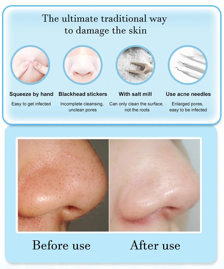 Blackhead Extractor 2.0